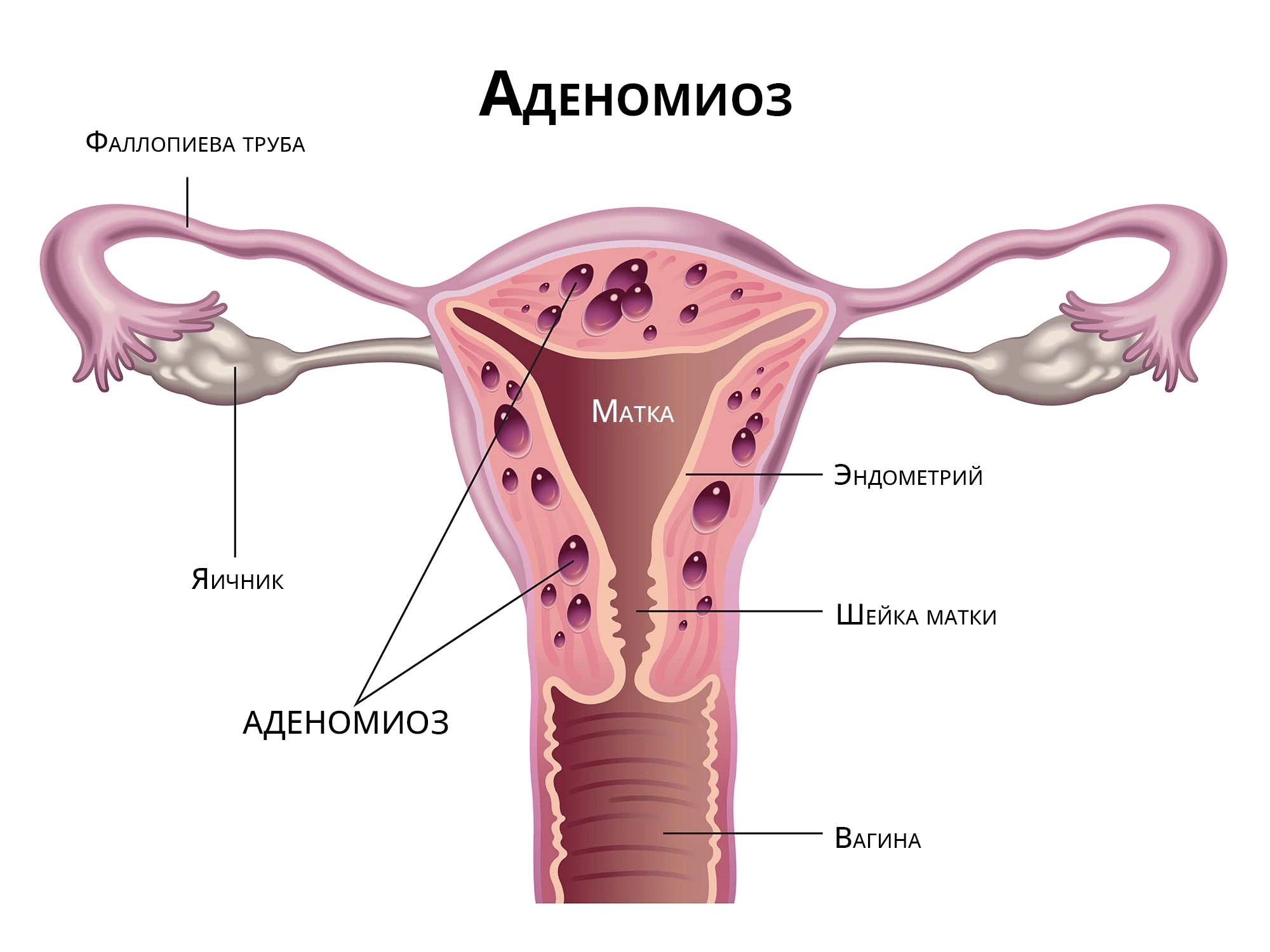 Возможно ли лечение эндометриоза матки народными средствами?