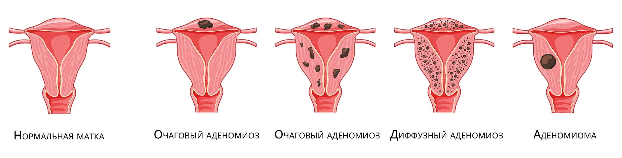 Аденомиоз и вероятность беременности