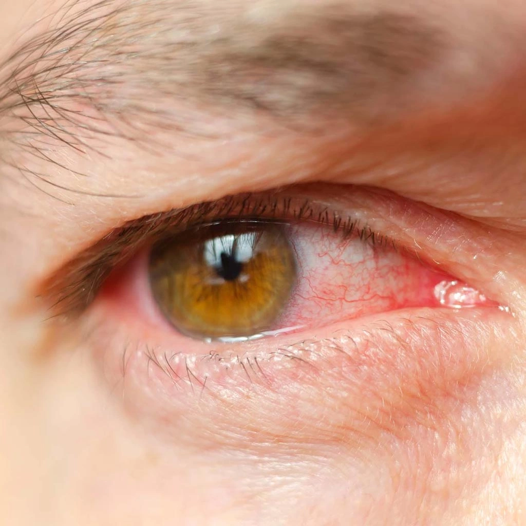 Аллергический конъюнктивит (болезни глаз): причины, симптомы, лечение | «Бест Клиник»