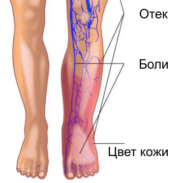 Тромбоз вен нижних конечностей карта смп