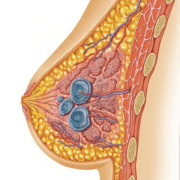Киста молочной железы лечение спб