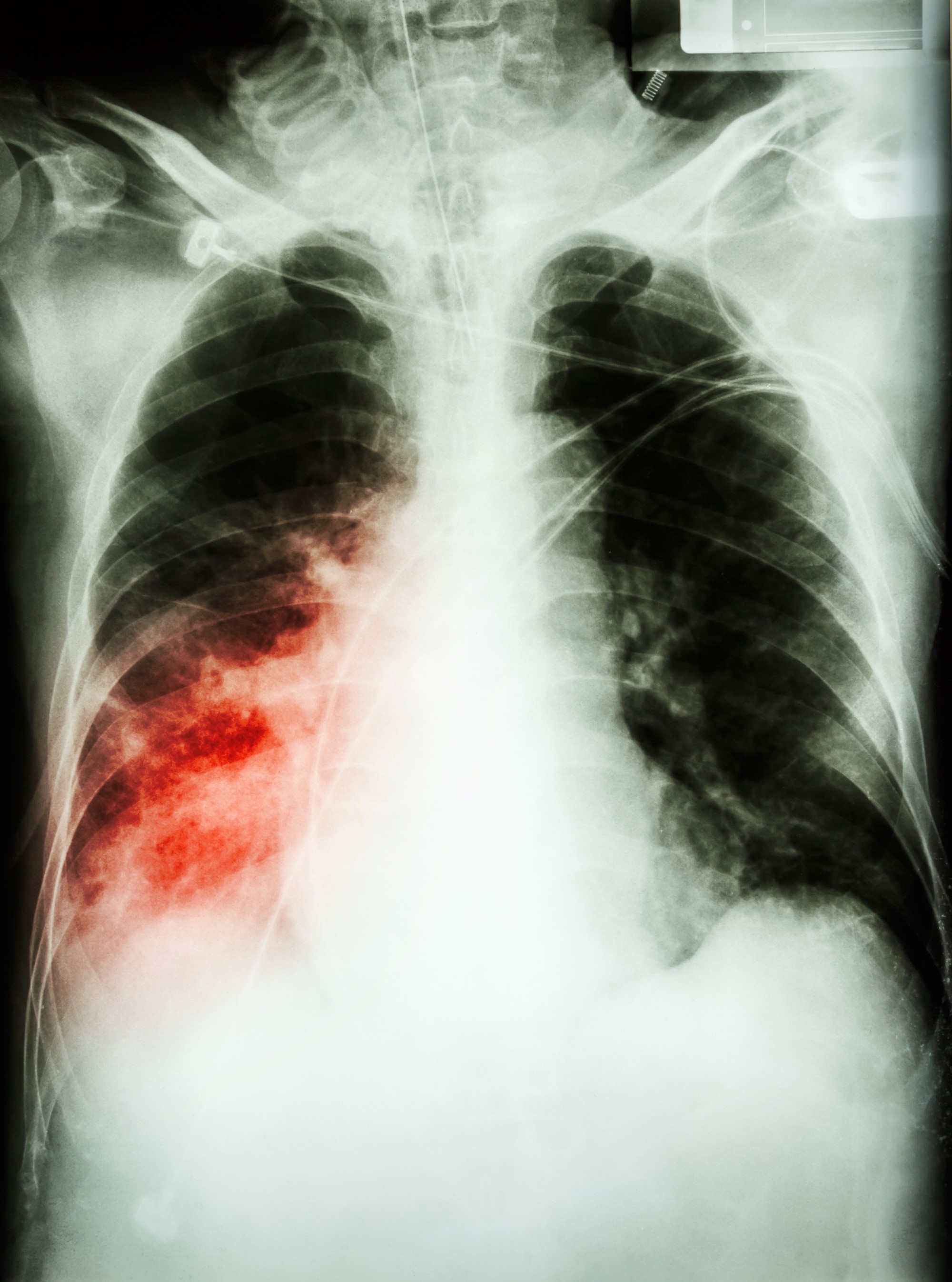 Снимки двухсторонней пневмонии