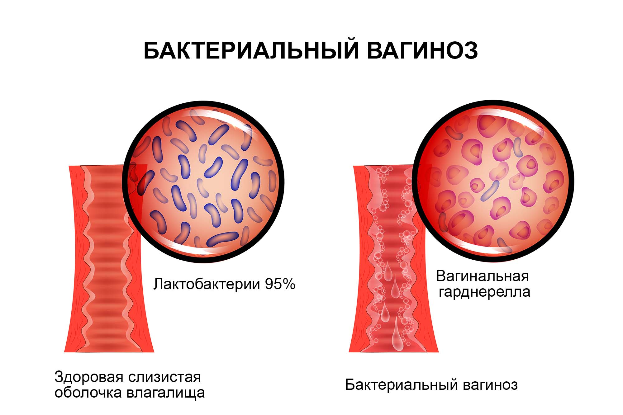 Бактериальный вагиноз возбудитель