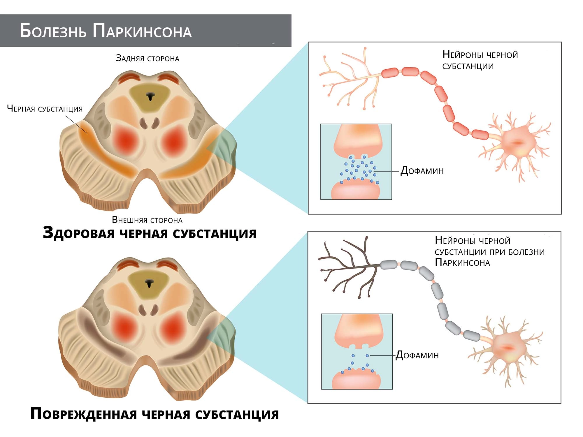 Болезнь Паркинсона: что это, симптомы, причины, диагностика, лечение