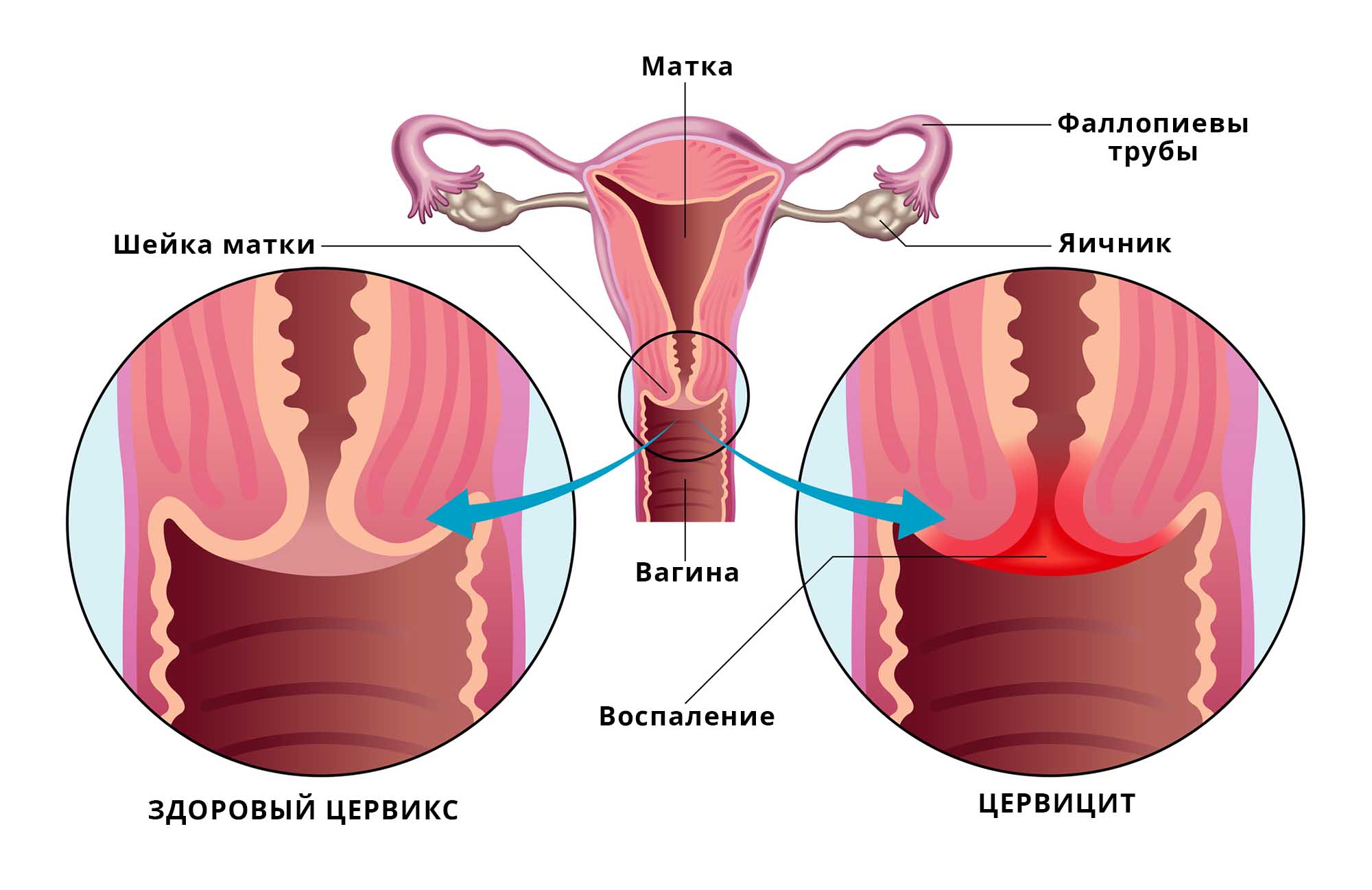 Цервицит