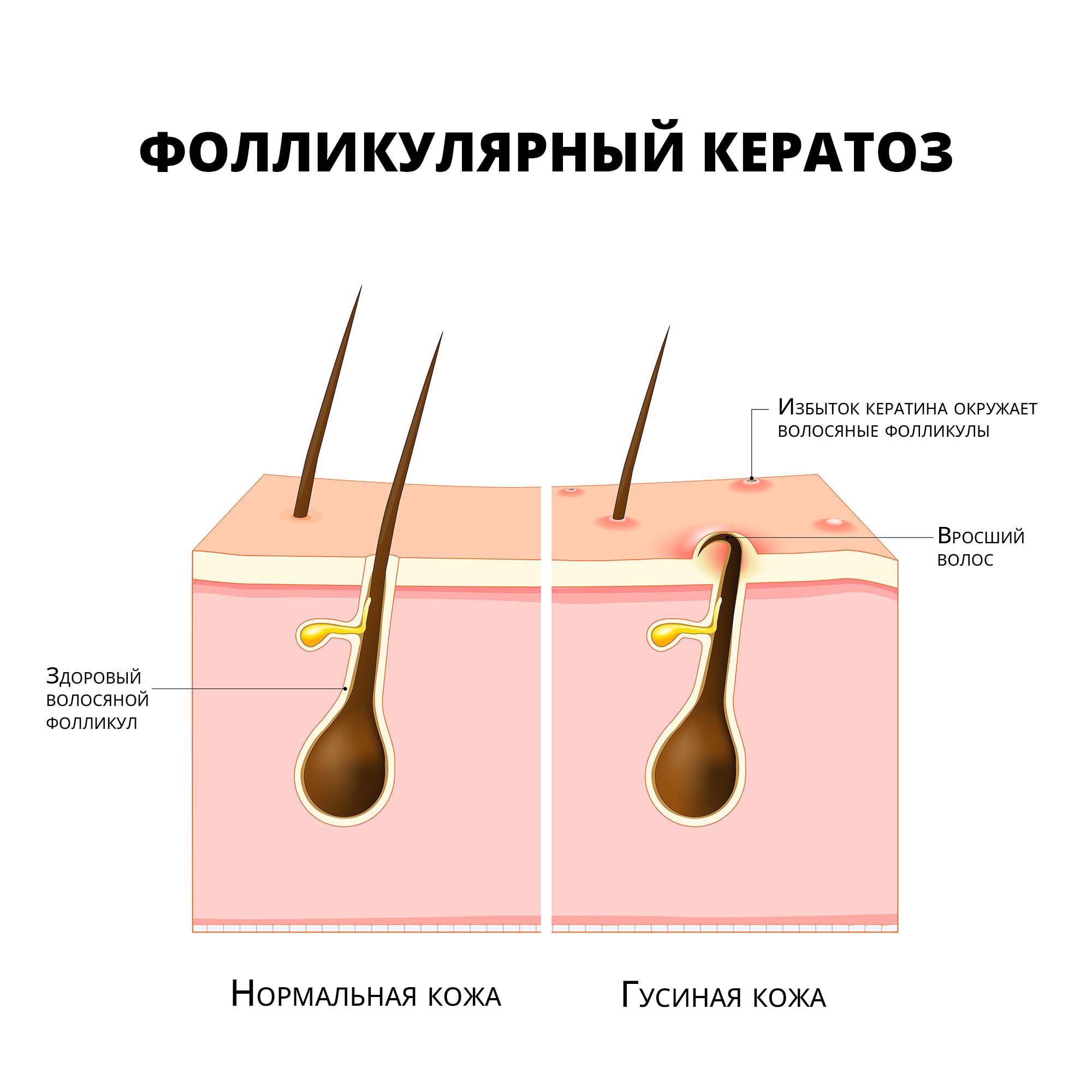 Фолликулярный кератоз: причины, симптомы, диагностика, лечение и уход