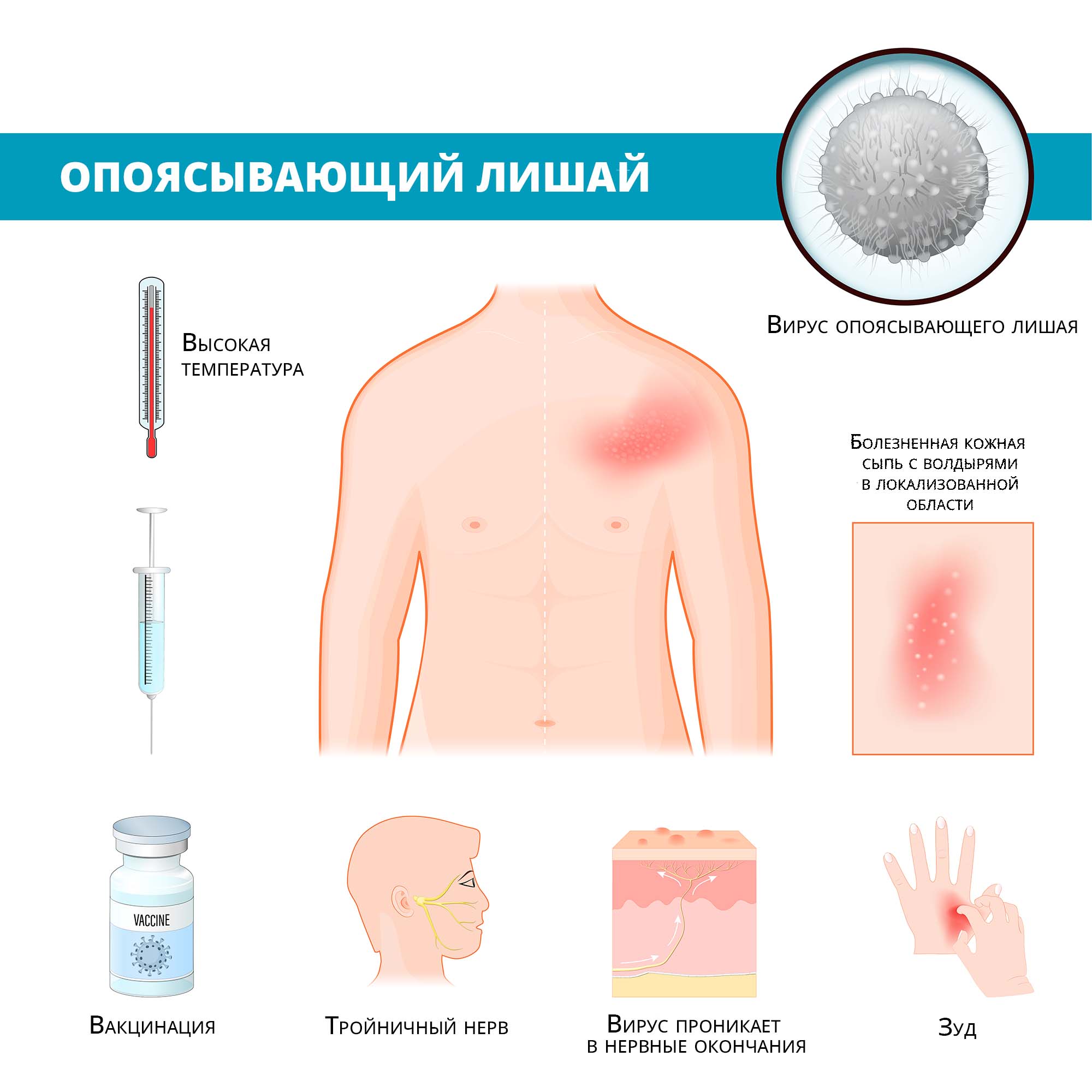 Опоясывающий лишай (герпес): причины, симптомы, лечение, заразен ли