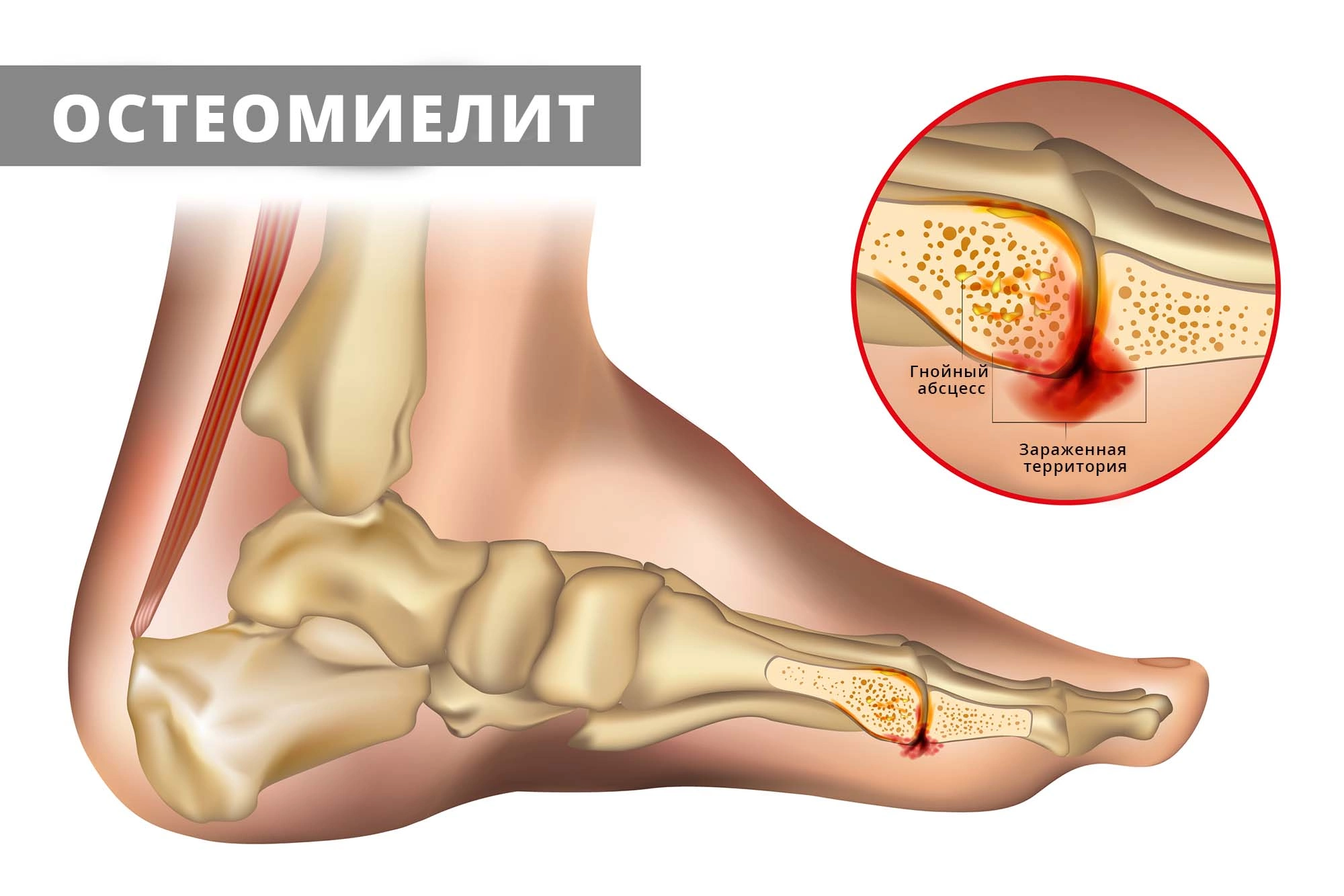 Остеомиелит: причины, симптомы, классификация, терапия, профилактика