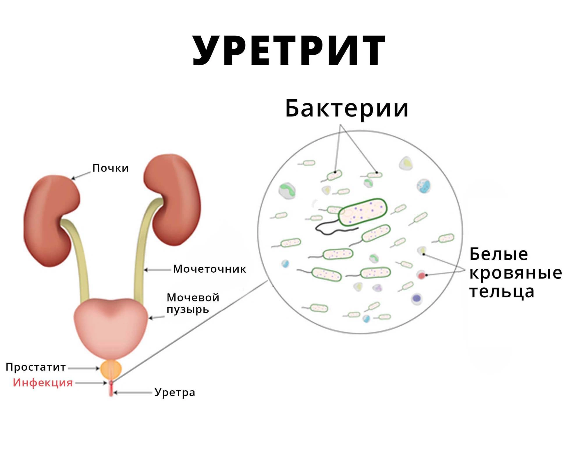 Уретрит: причины, симптомы, чем опасен, терапия, профилактика воспаления  уретры