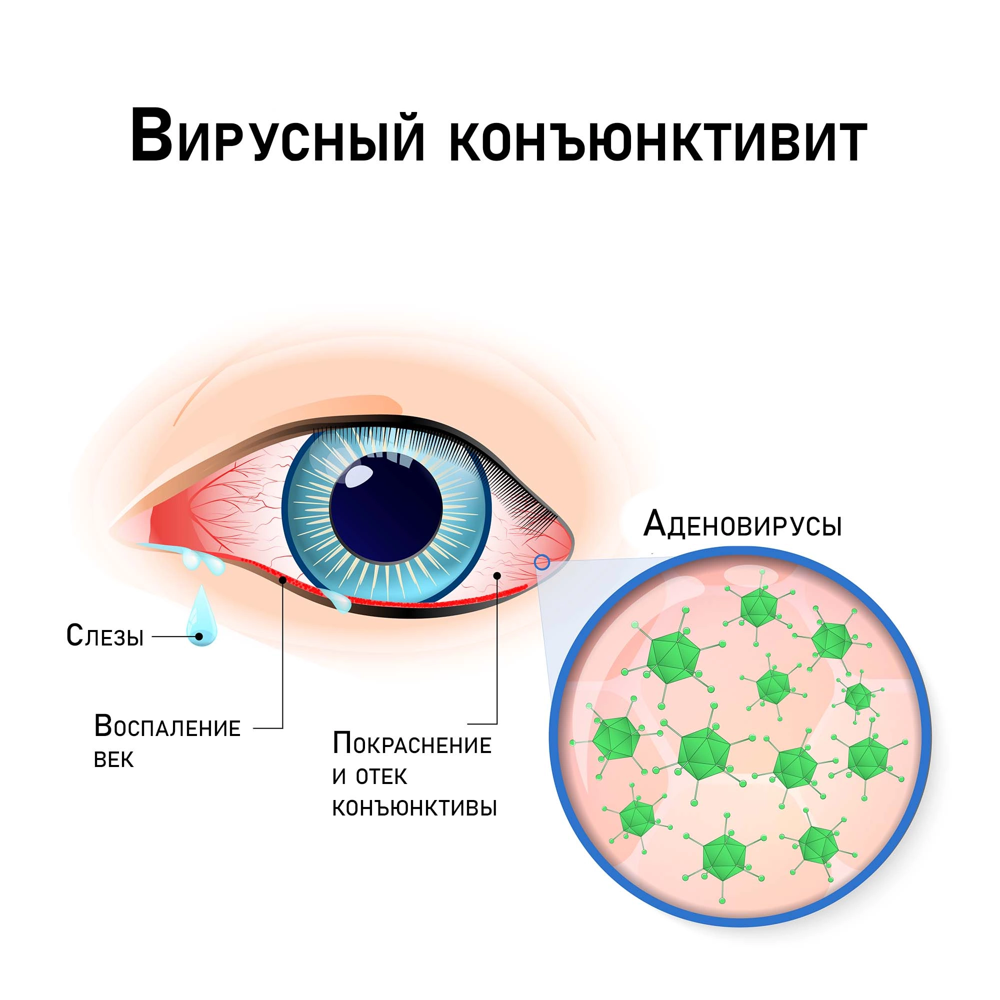 Вирусный конъюнктивит - Заболевания глаз - Справочник MSD Профессиональная версия