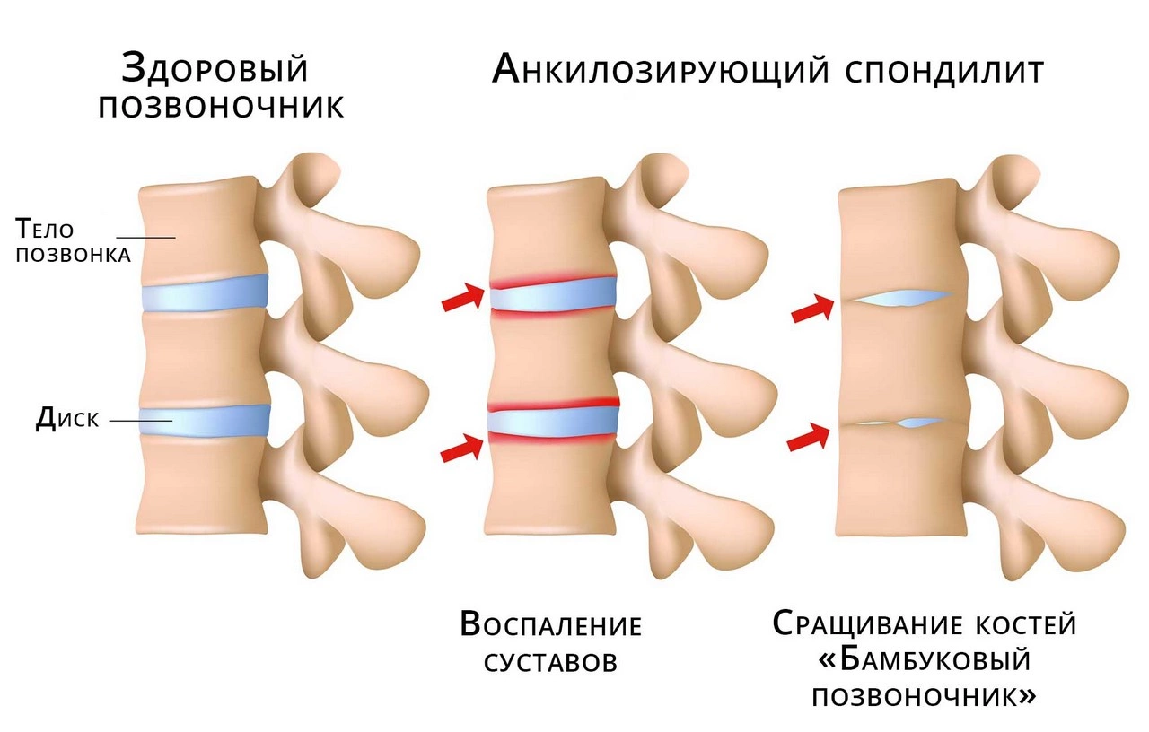 Заболевания в ревматологии: симптомы и лечение