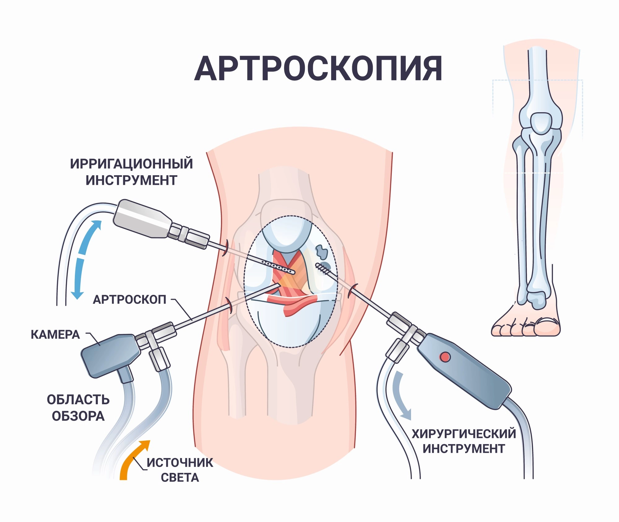 Эффективное лечение мениска коленного сустава народными методами