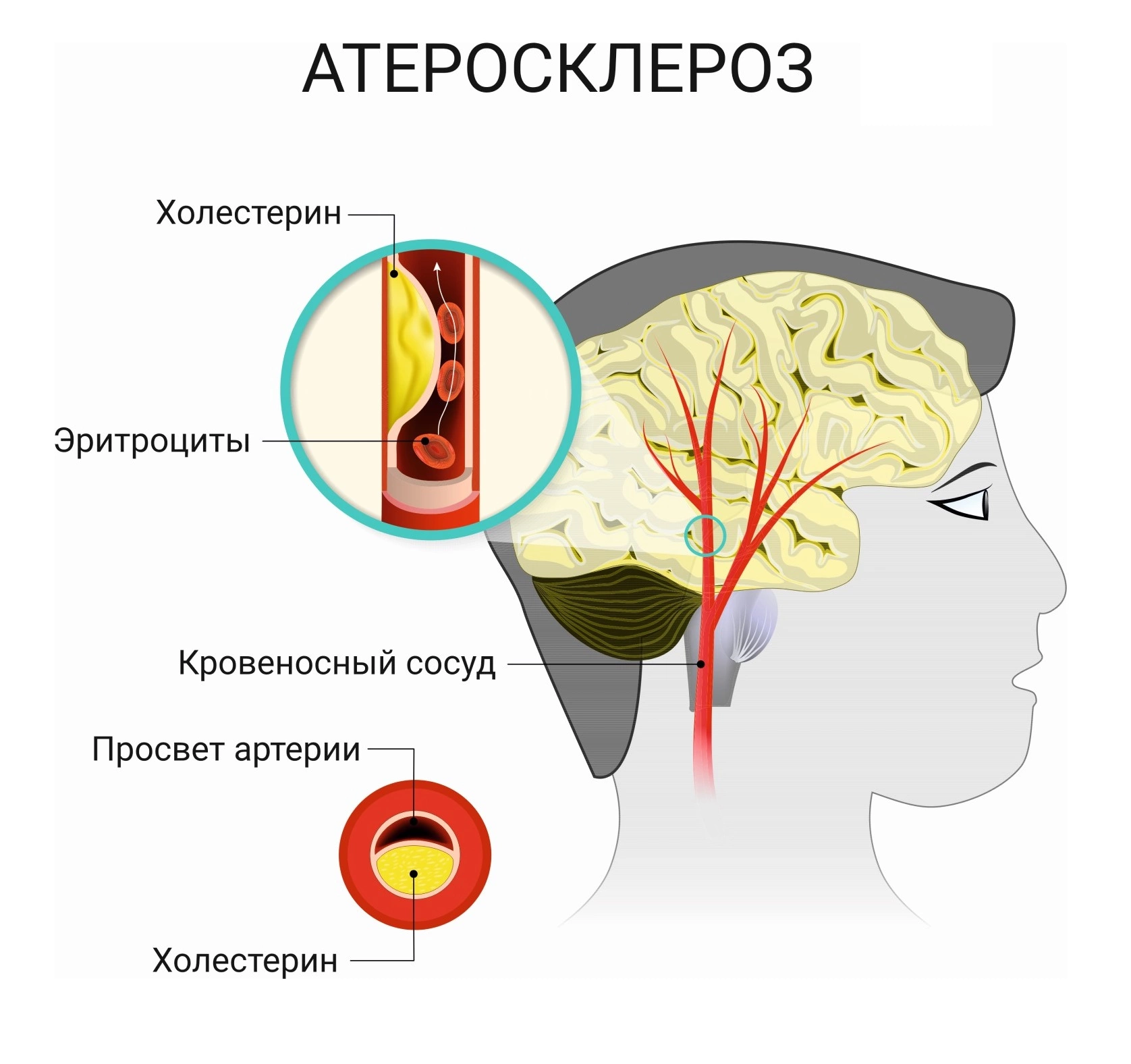 Атеросклероз сосудов головного мозга: симптомы и лечение, признаки,  препараты
