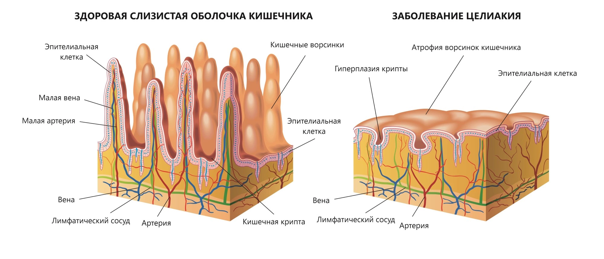 Целиакия клиническая картина