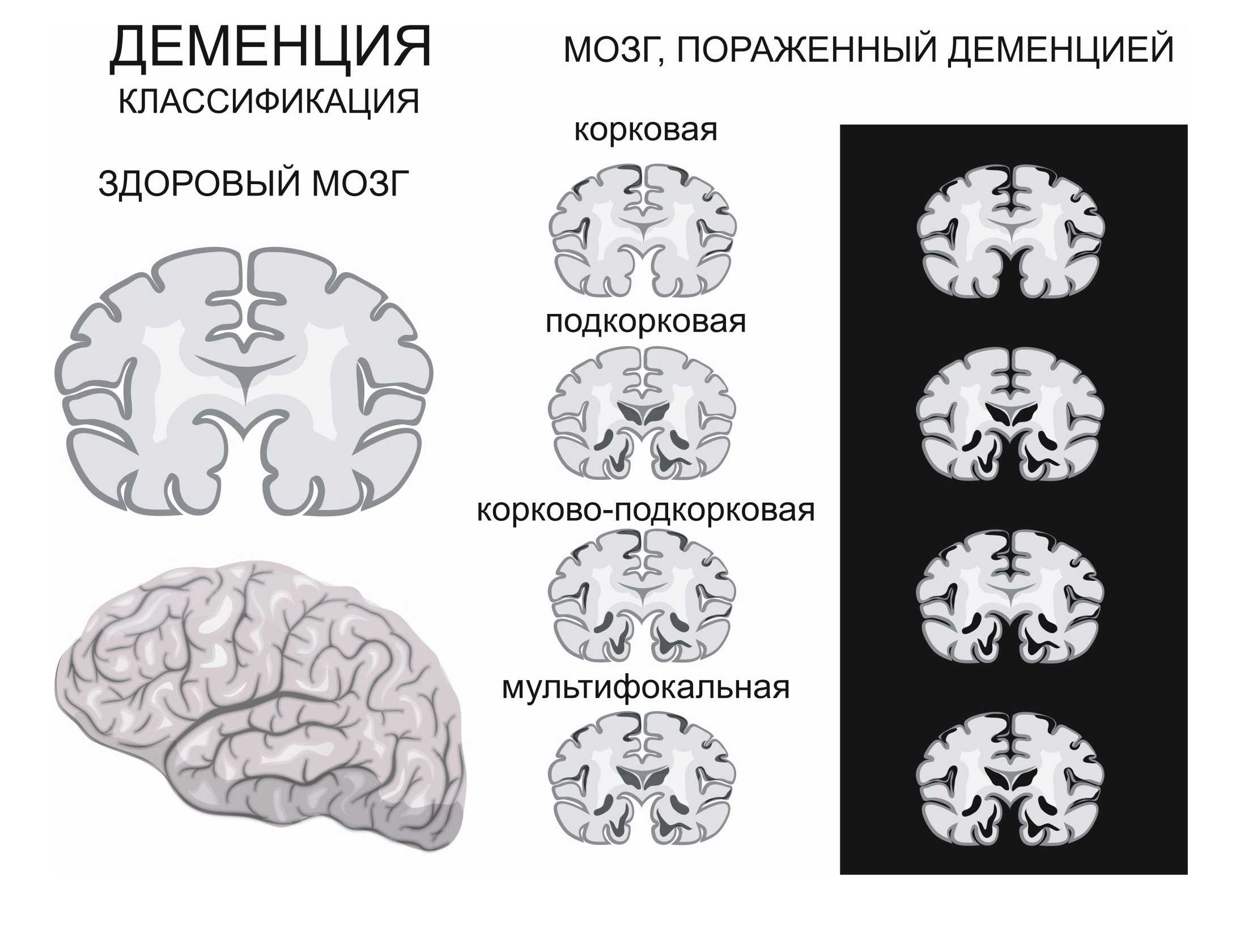 Деменция: что это за болезнь, симптомы, причины, признаки, лечение,  профилактика