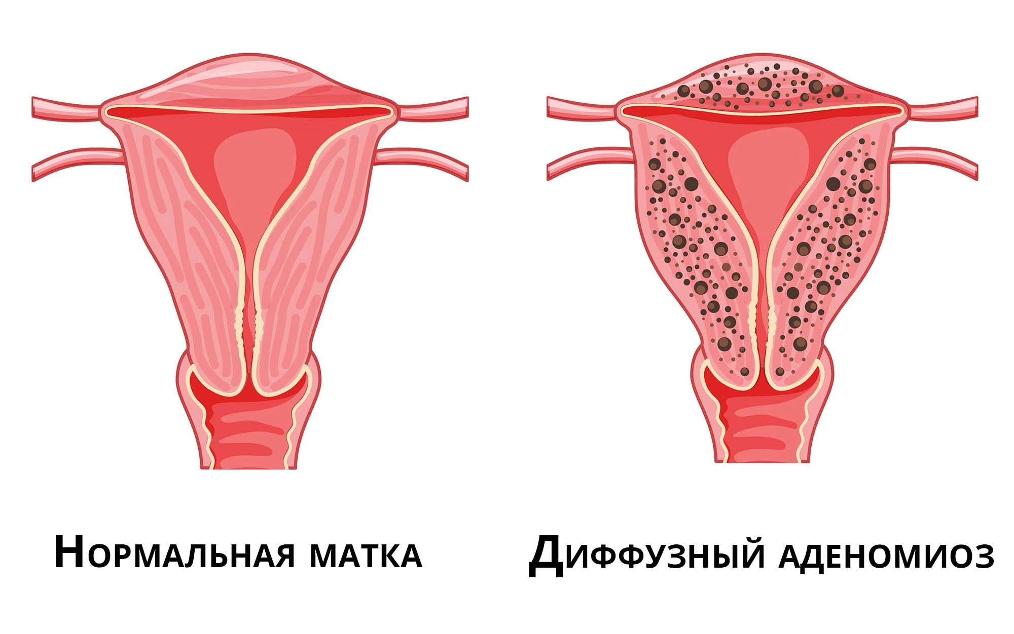 Чем лечить воспаление по женски: воспаление яичников, другие