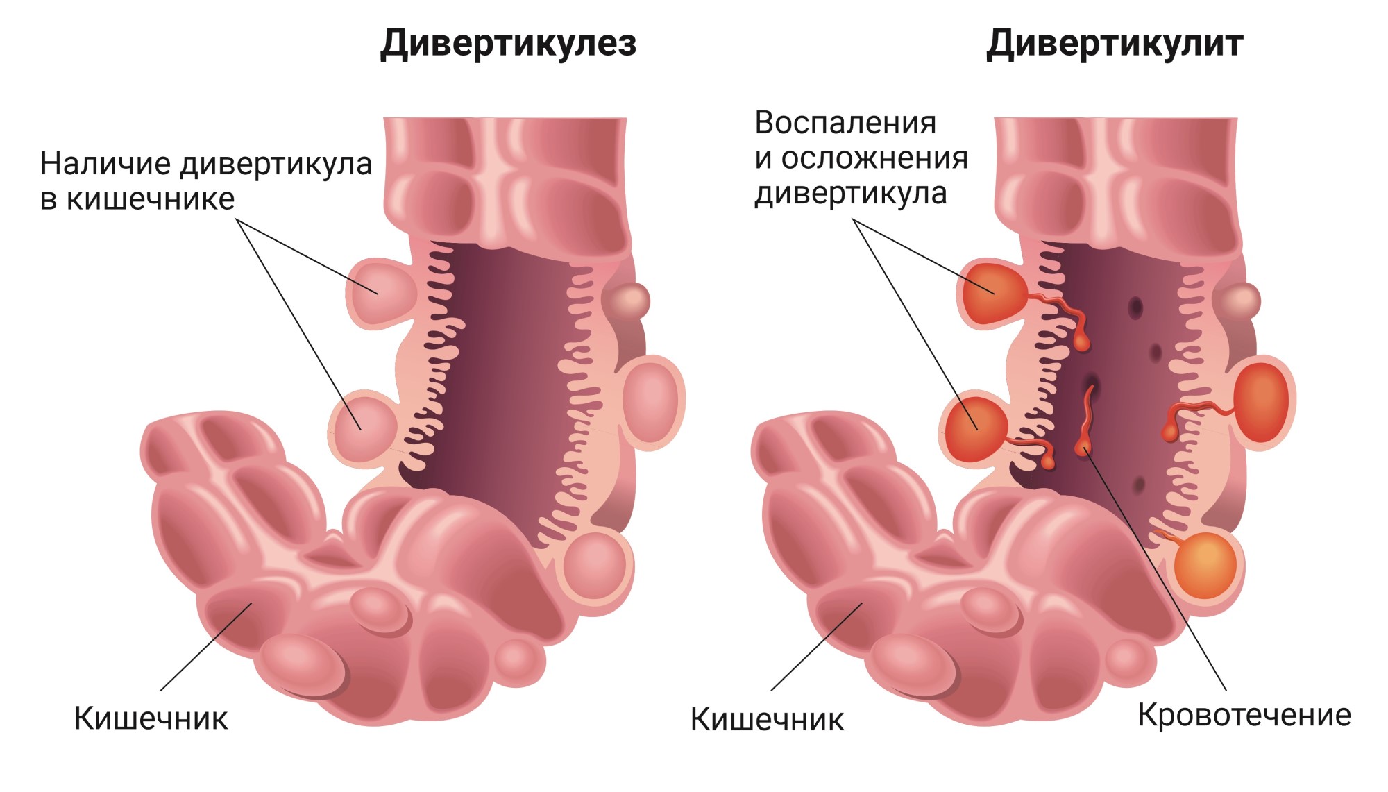 Дивертикулёз толстой кишки патогенез