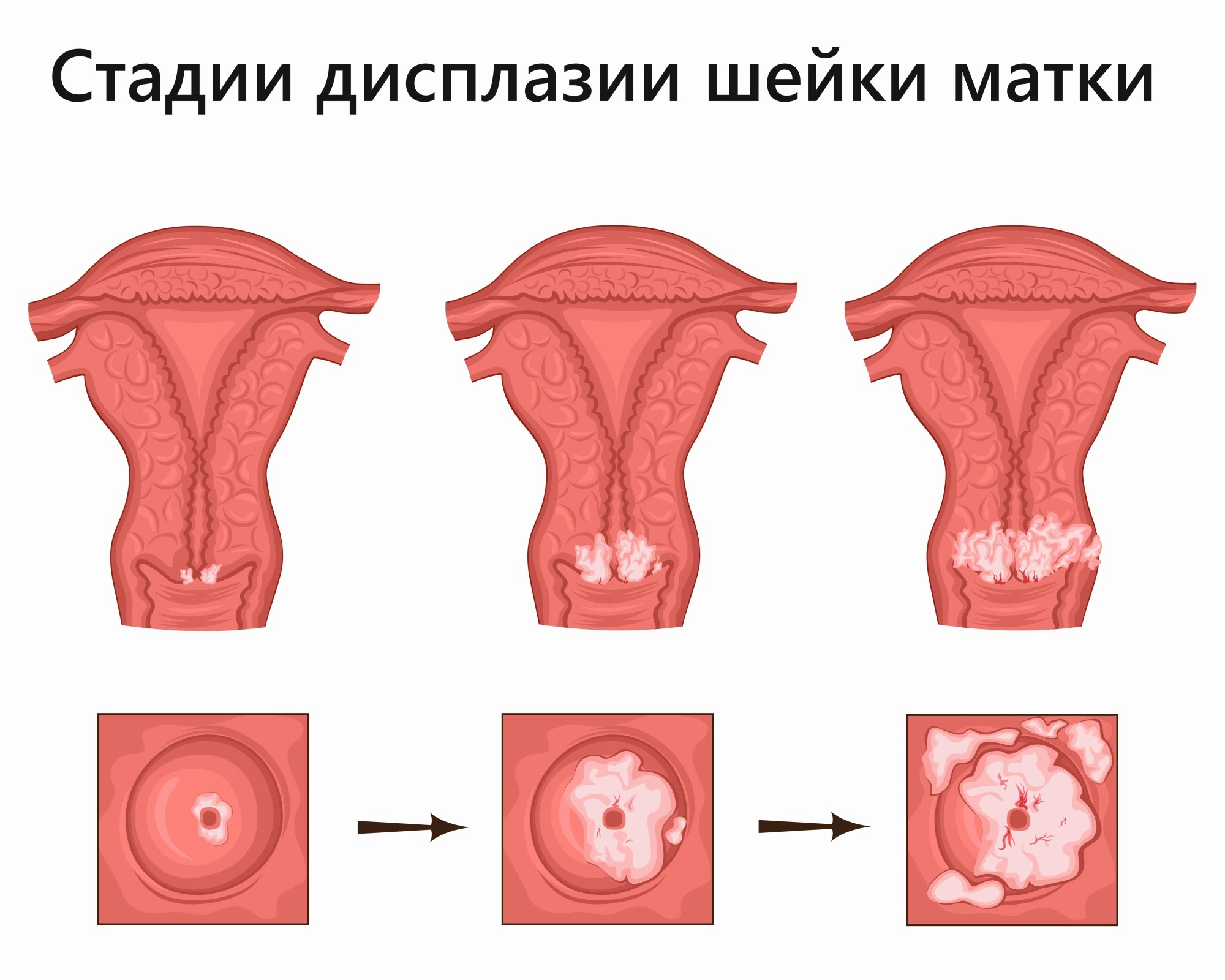 Дисплазия шейки матки - причины появления, симптомы заболевания, диагностика и способы лечения