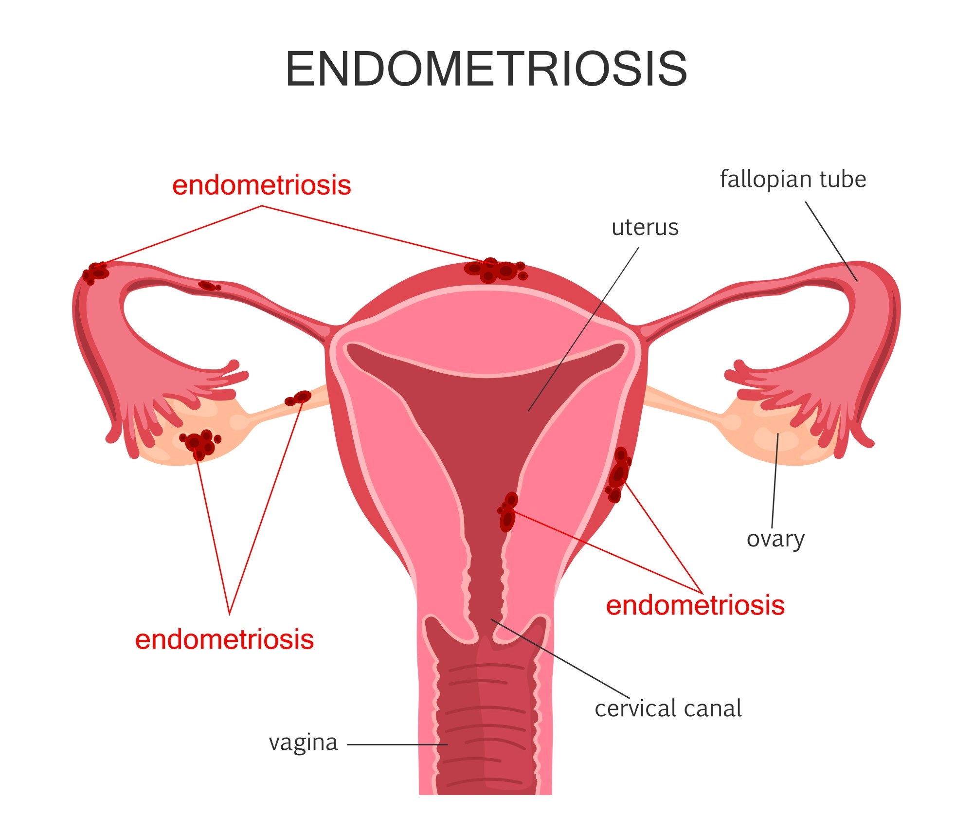 Эндометриоз - Симптомы, лечение - Медицинский справочник АМК