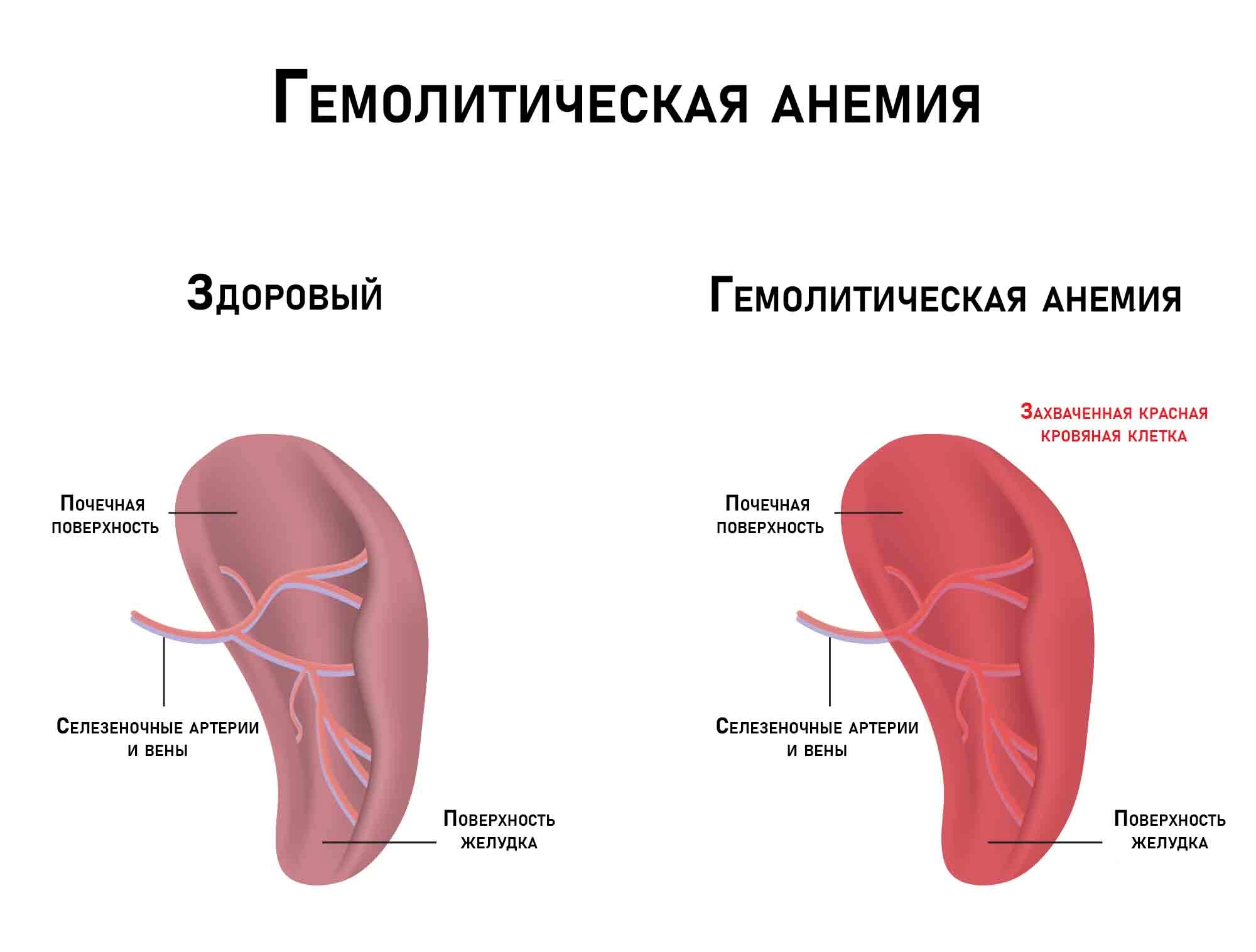 Гемолитическая анемия: симптомы, причины, классификация, диагностика,  лечение