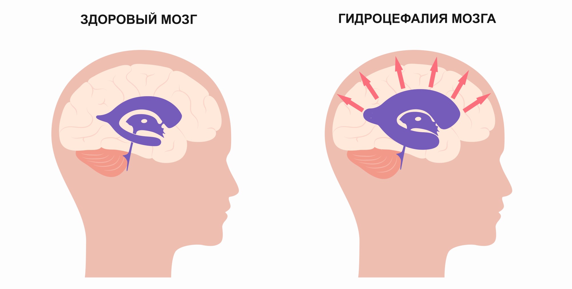 Опухоль головного мозга где болит голова