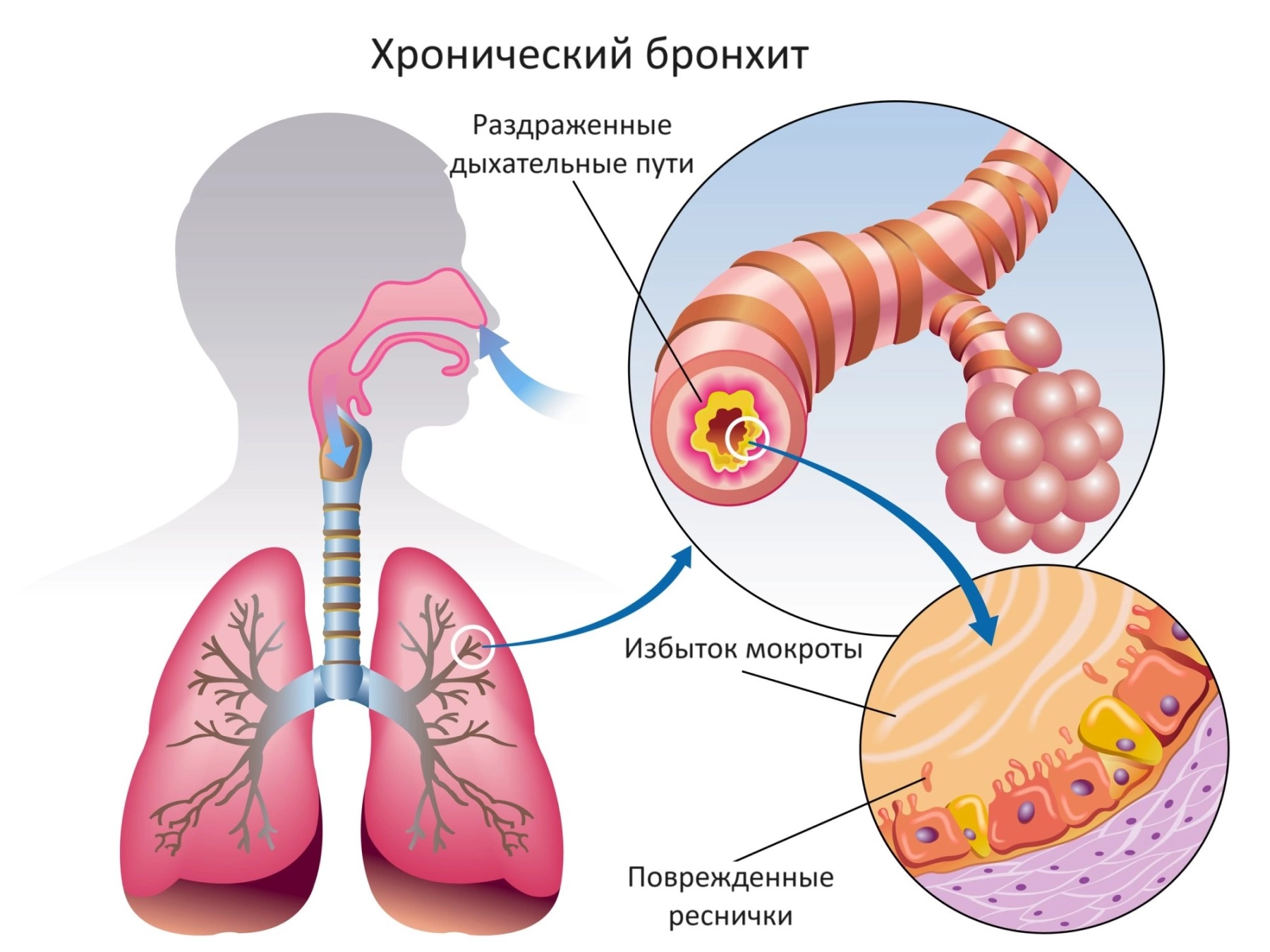 Бронхит у пожилых людей: лечение медикаментозными и народными средствами