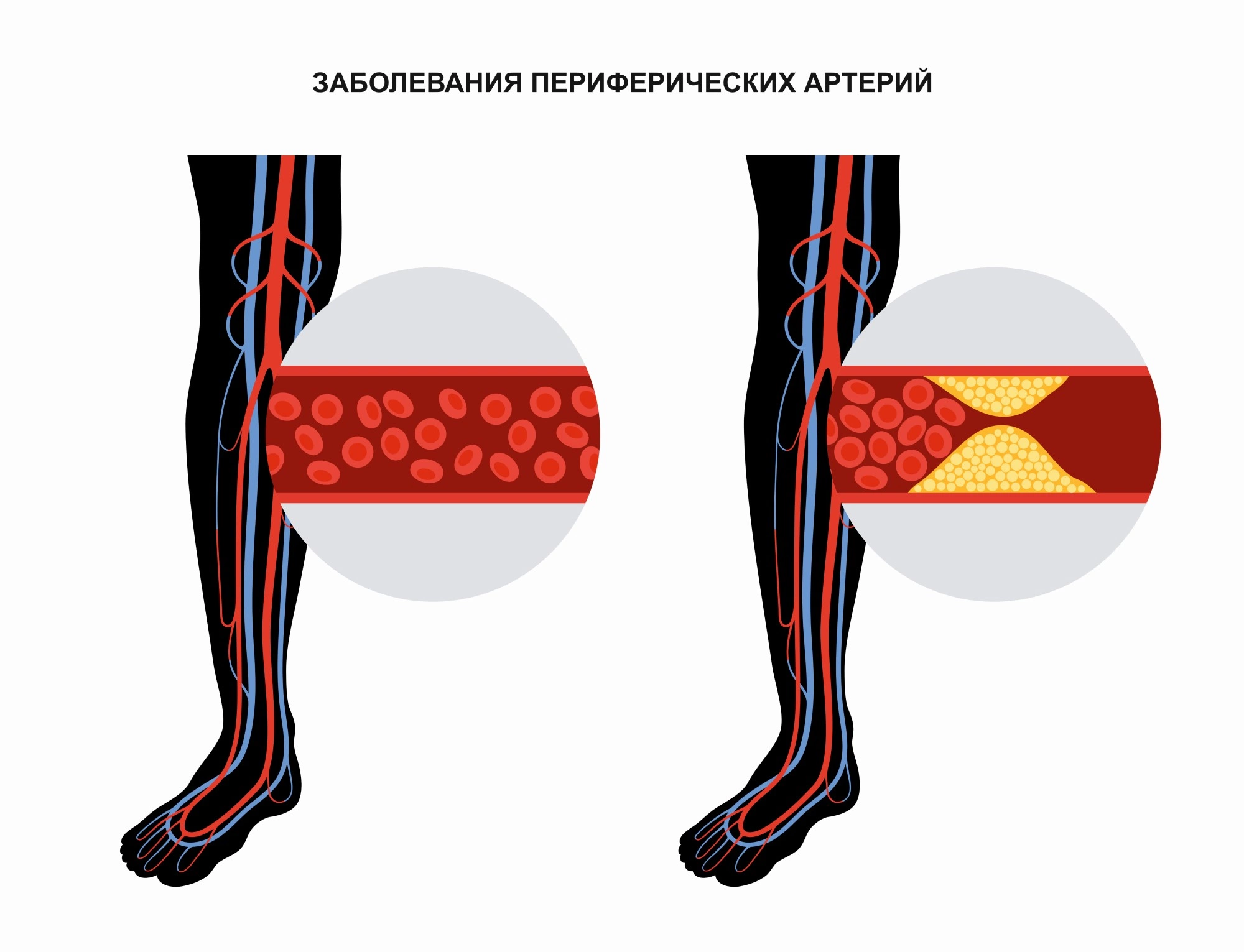 Ишемия нижних конечностей - классификация, лечение ног, стадии, симптомы