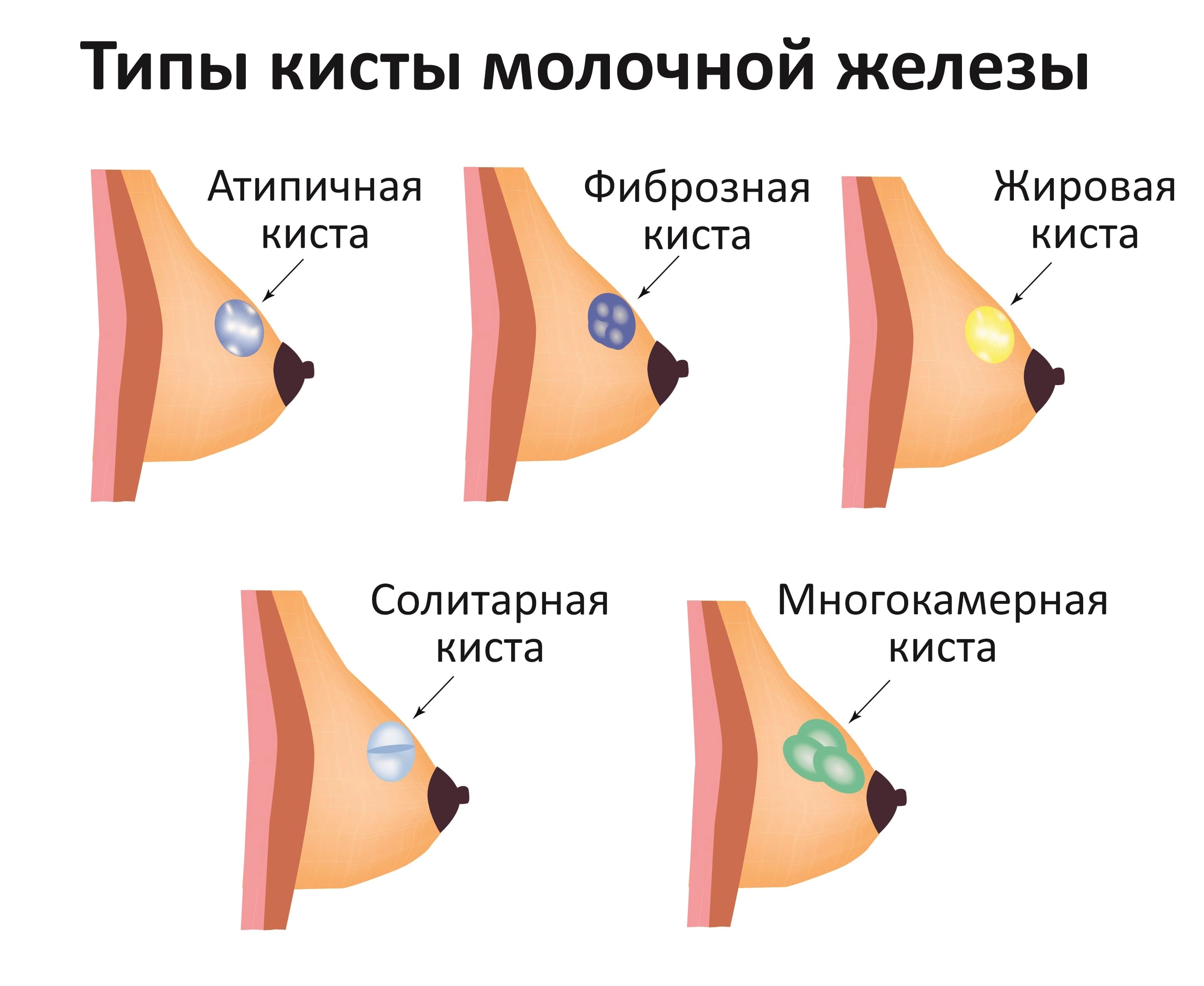 Киста молочной железы - диагностика и лечение опухоли в Москве