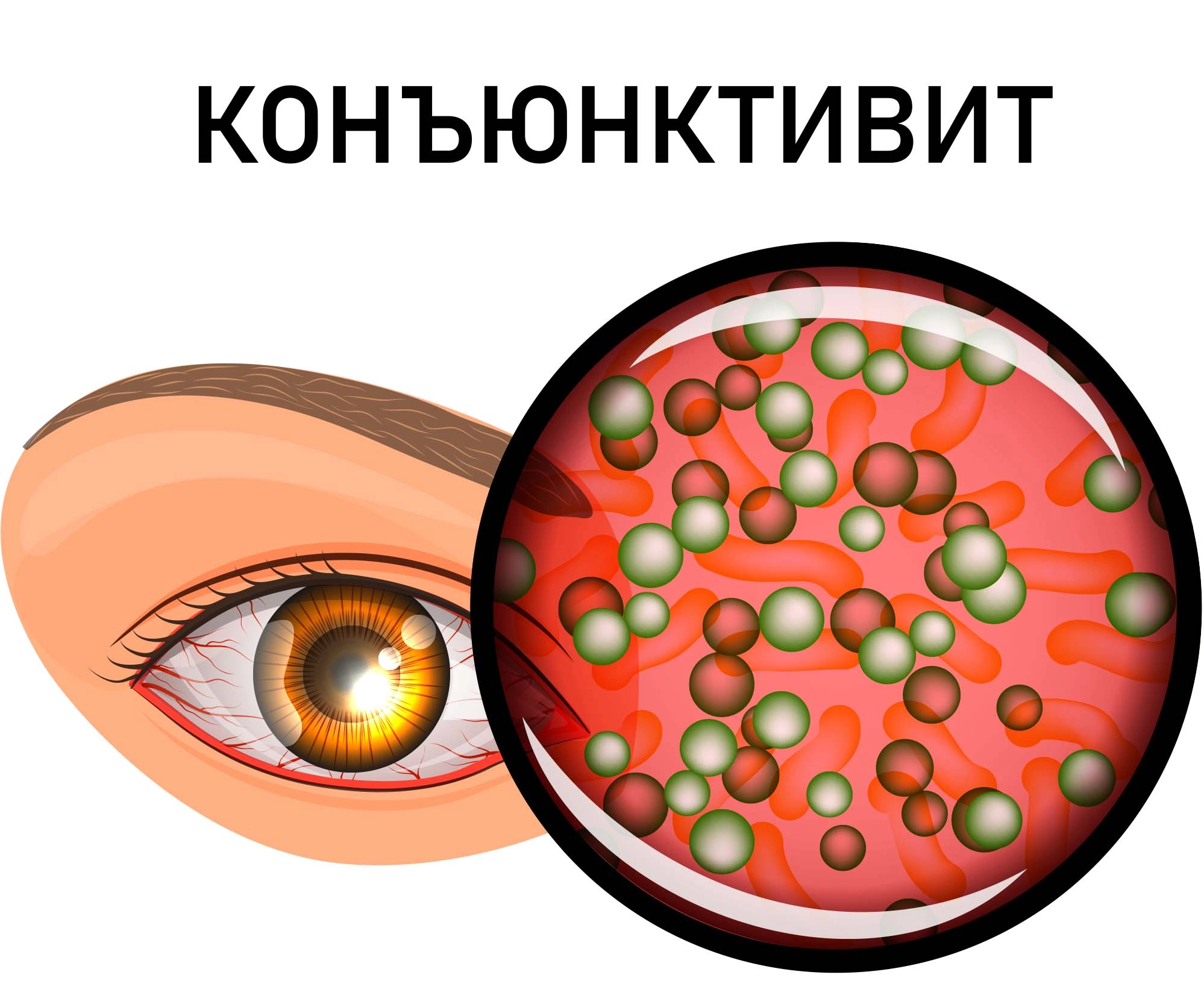 Конъюнктивит: причины, симптомы, признаки, осложнения, лечение, профилактика