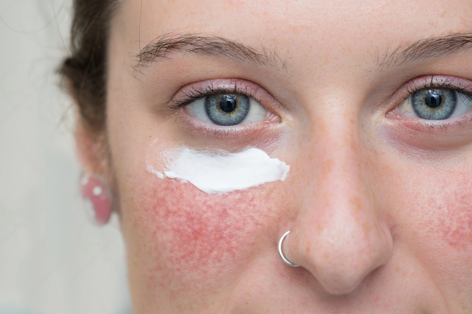 Почему лопаются капилляры на коже лица и как с этим справиться