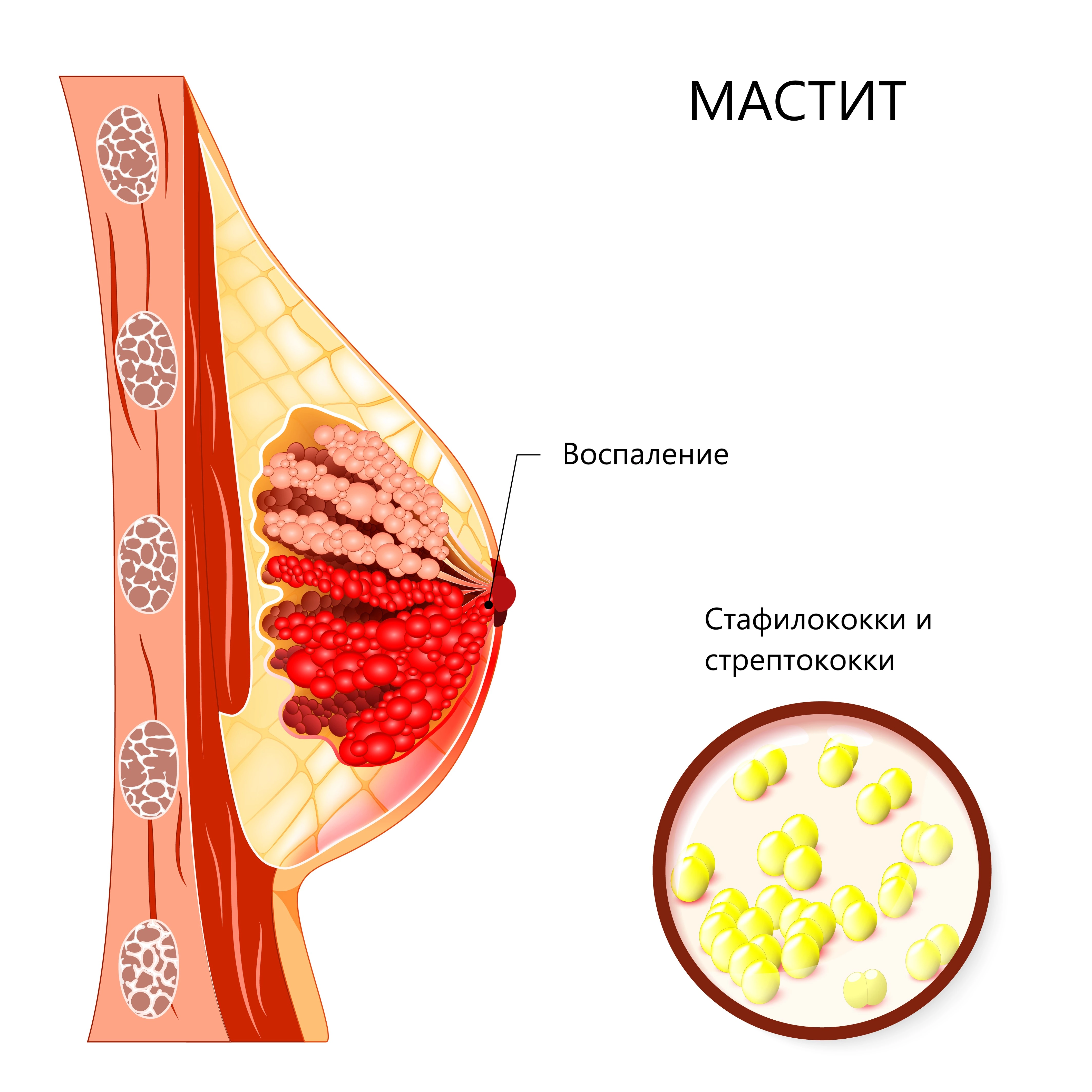 Lactation mastitis