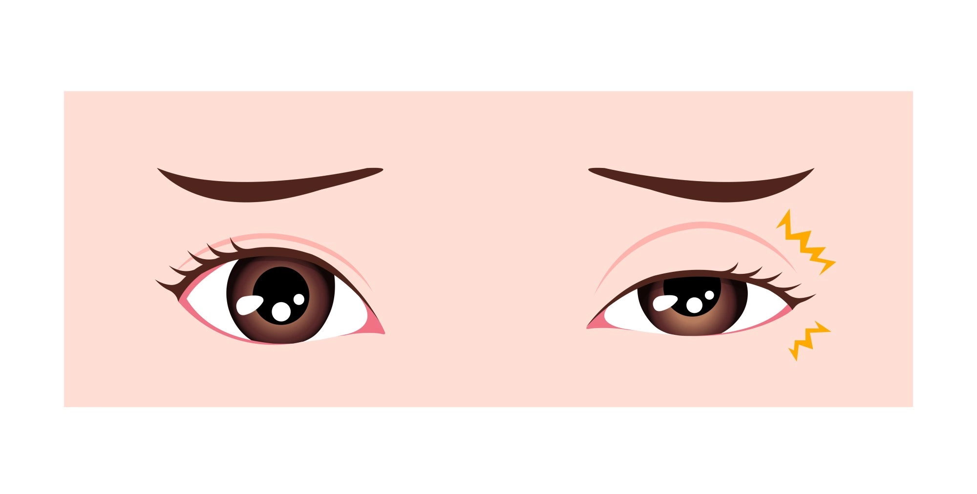 Подергивание глаз: 8 причин, способы лечения, профилактика