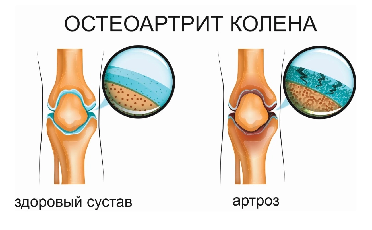 Остеоартрит - лечение, симптомы, что за болезнь, признаки