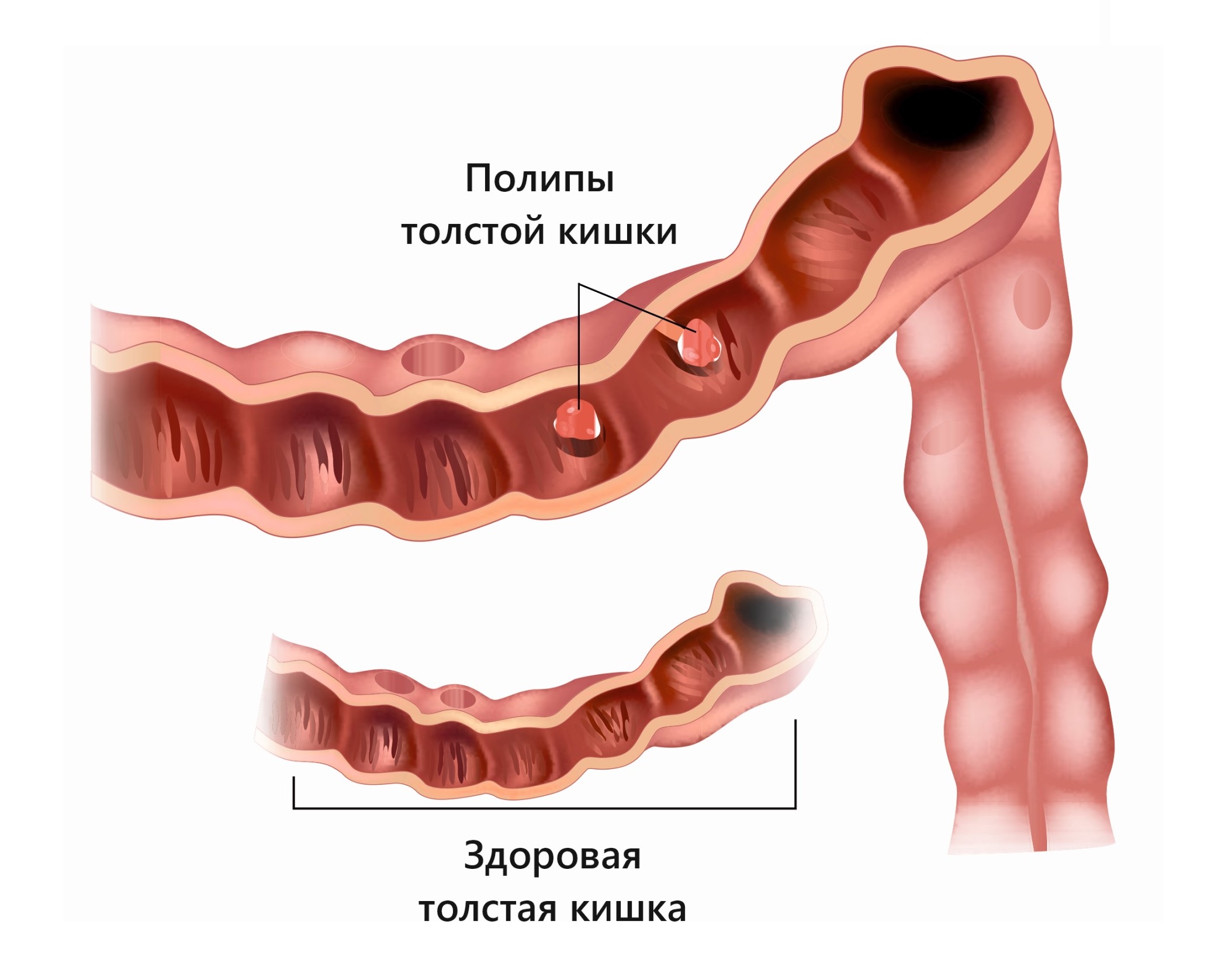 Аденоматозный полипоз кишечника