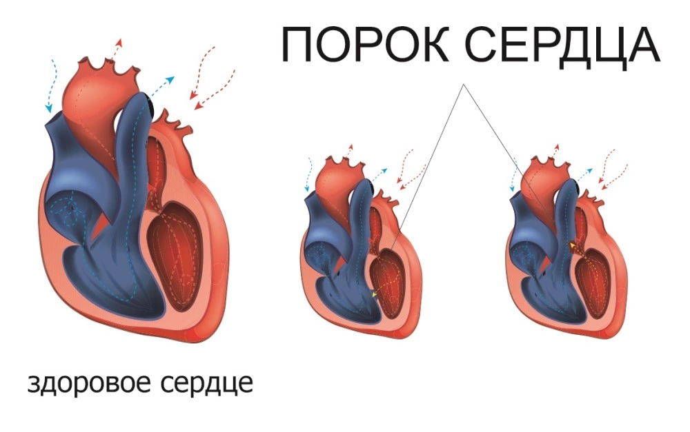 Ишемическая болезнь сердца: атеросклеротический кардиосклероз, инфаркт миокарда, стенокардия.