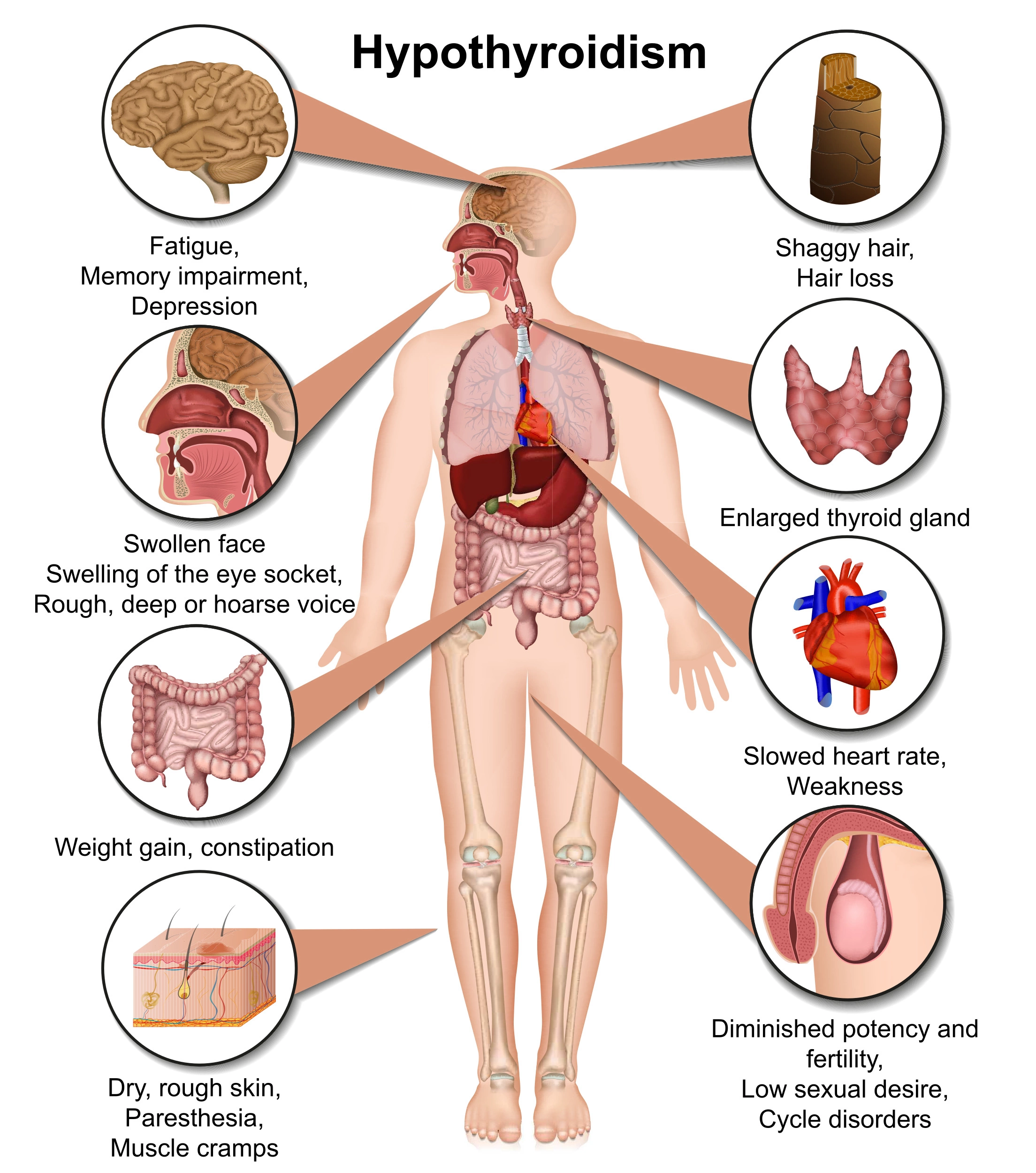 Гипотиреоз: причины, симптомы и как его лечить?