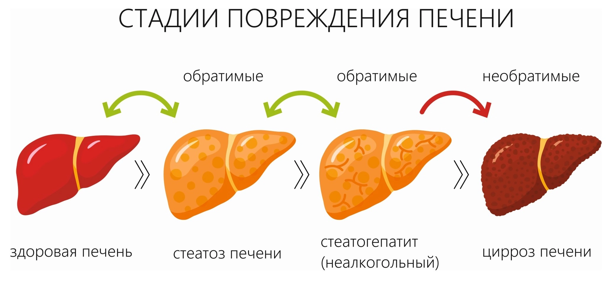 Цирроз печени: стадии, симптомы и лечение в Москве в ФНКЦ ФМБА России